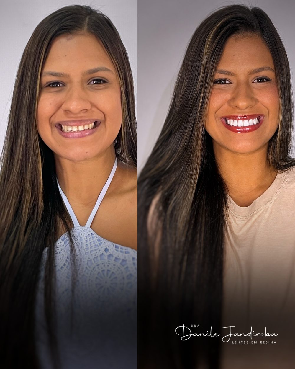 Antes e depois de um sorriso: à esquerda, dentes antes do tratamento; à direita, depois das lentes em resina