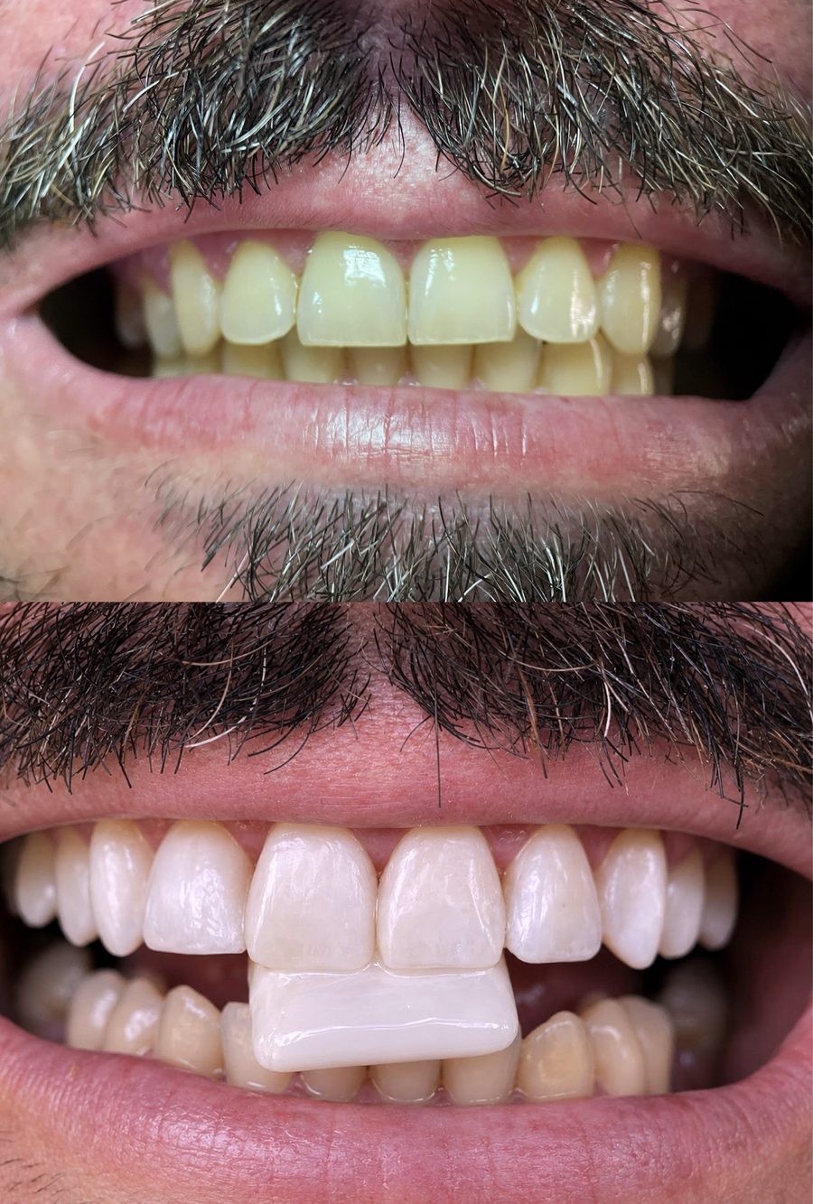 Antes e depois de dentes da frente: em cima, antes do tratamento; embaixo, depois das lentes em resina